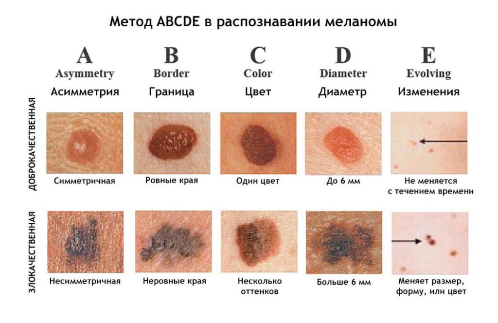 МЕЛАНОМА