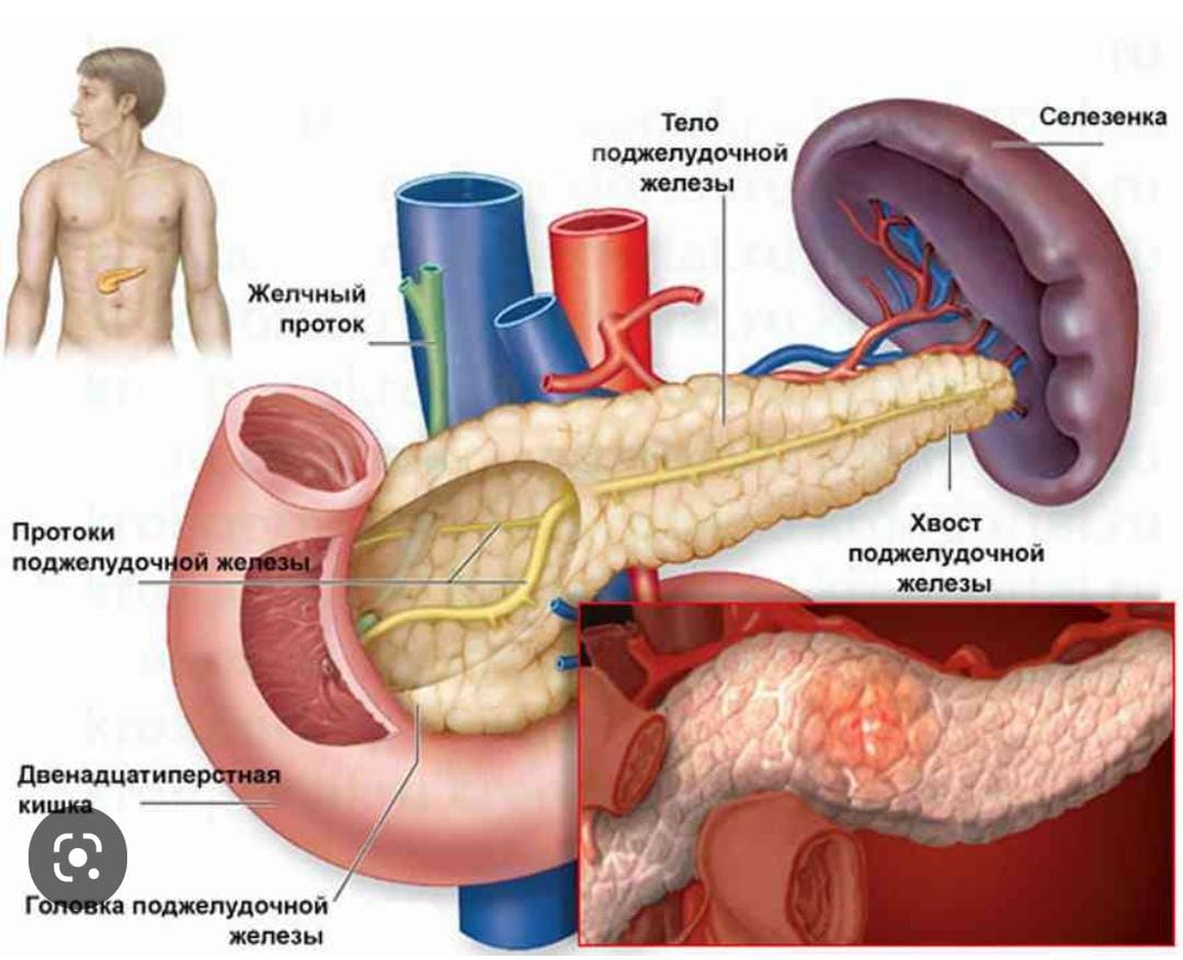 Вода в поджелудочной железе. Билиарнозависимый панкреатит симптомы. Острый панкреатит поджелудочной железы. Поджелудочная железа анатомия. Воспалённая поджелудочная железа.