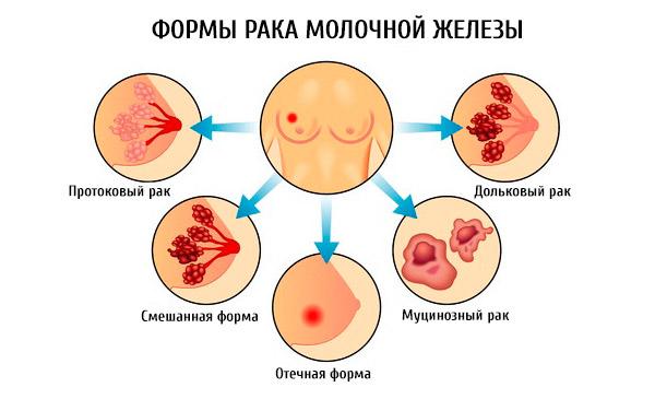 РАК МОЛОЧНОЙ ЖЕЛЕЗЫ