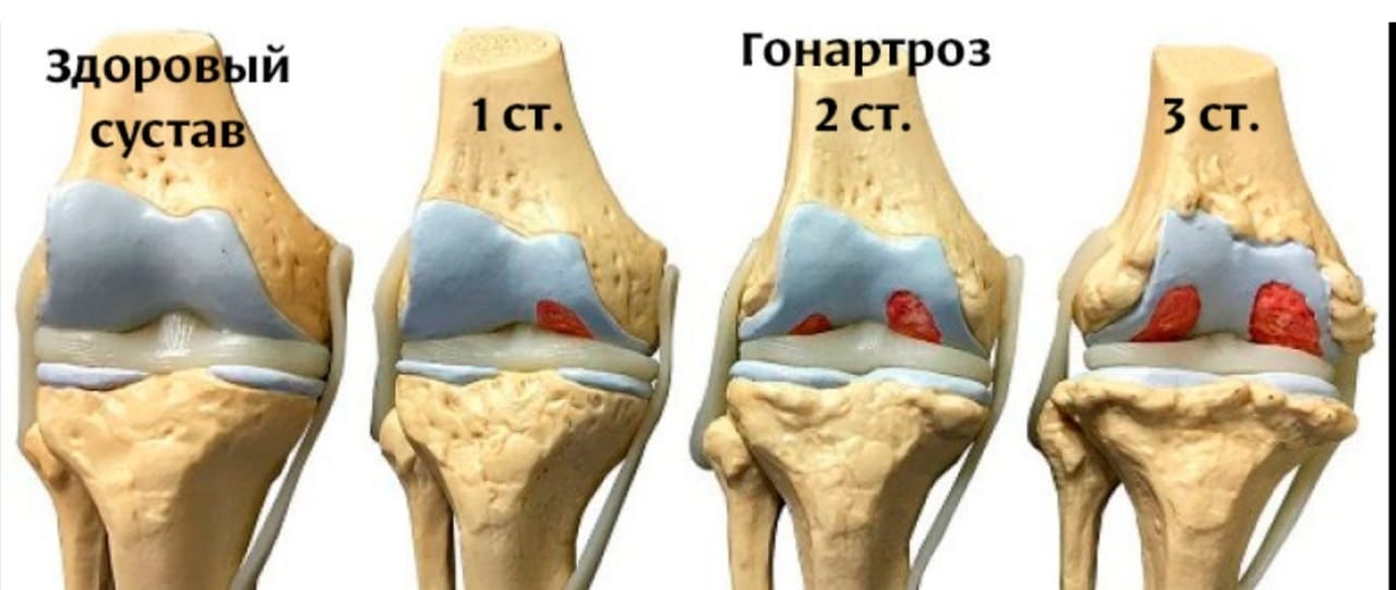 Остеоартроз это. Гонартроз коленного сустава. Гонартроз коленного сустава 2. Гонартроз эндопротезирование коленного сустава.